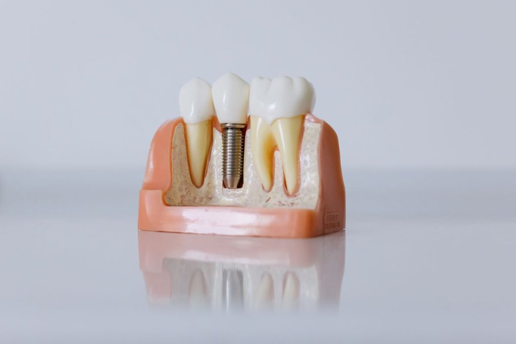 Diş implantı ve üst yapısını gösteren model